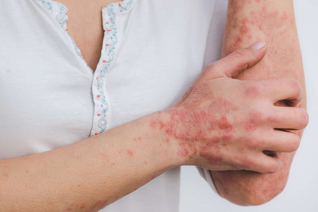 skincare for psoriasis